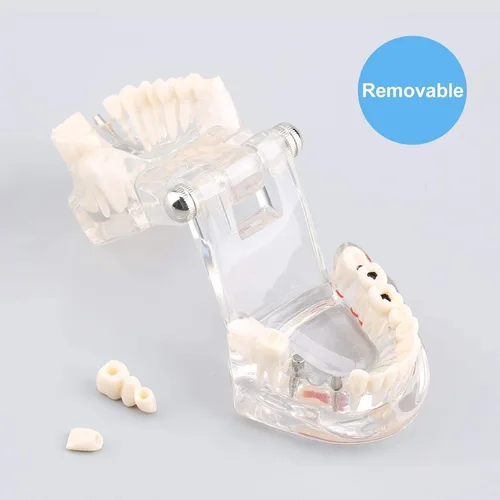 Vista 7 de Jeanoko Modelo de diente transparente Modelo de dientes de enfermedad de implante dental Modelo de dientes de demostración de Typodont adulto