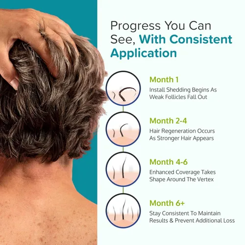 Vista 8 de Regoxidine Men's 5% Minoxidil Foam ayuda a restaurar la pérdida de cabello vértices y apoya el crecimiento del cabello con tratamiento tópico sin