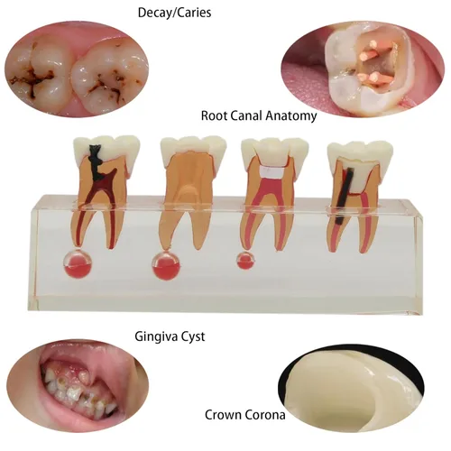 Vista 5 de Modelo de tratamiento endodóntico Dentalmall, de cuatro etapas, para enseñar a estudiantes, modelo 4018