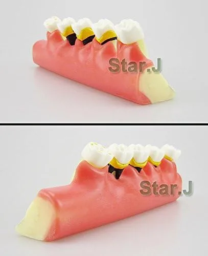 Vista 2 de Dental Periodontal Disease assort Dientes Dientes Typodont Estudio Modelo de Enseñanza Nuevo