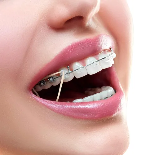 Vista 5 de 500 Piezas Bandas de Goma Elásticas Ortodónticas Bandas de Tracción de Goma para Dientes Torcidos, Espacios entre Dientes, Diademas, Colas