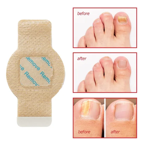 Vista 4 de Parches de uñas para uñas de los pies, 21 unidades, bolsa de uñas extra fuertes, reparación nocturna de uñas dañadas y decoloradas, seguro
